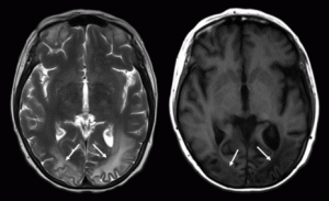 Posterior reversible encephalopathy syndrome